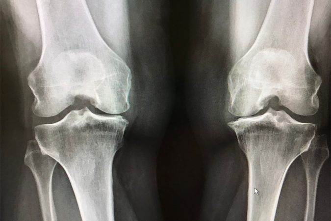 What-is-Osteoarthritis